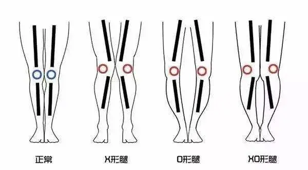 海宁8岁男孩走路姿势怪，医院一查：恢复难，要吃苦头…很多孩子已中招