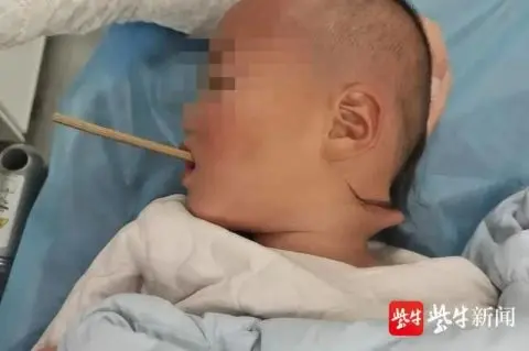 太揪心！一根筷子把2岁多孩子的脖子戳穿！