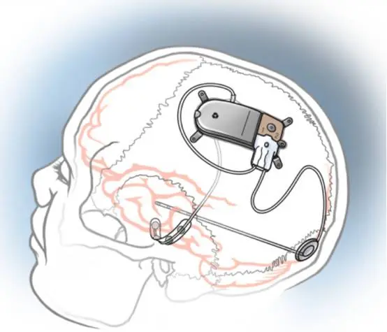 马斯克产业布局之—脑机接口Neuralink，赛博朋克时代的到来