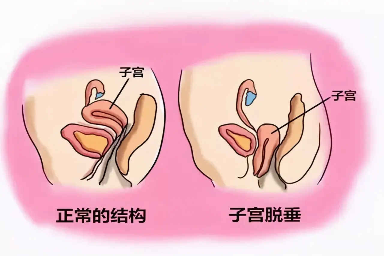 产妇顺产半个月后，身体排出“一块肉”，检查结果显示要切除子宫