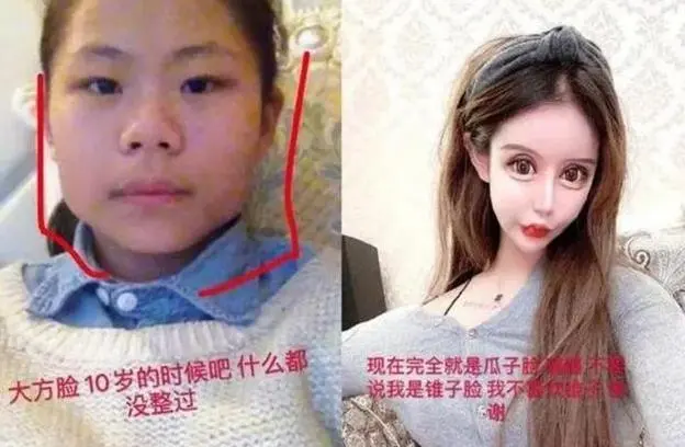 还记得整容花费近百万的少女吗？声称母亲支持，前后对比如换脸