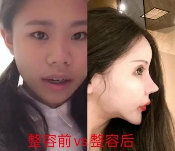 还记得整容花费近百万的少女吗？声称母亲支持，前后对比如换脸