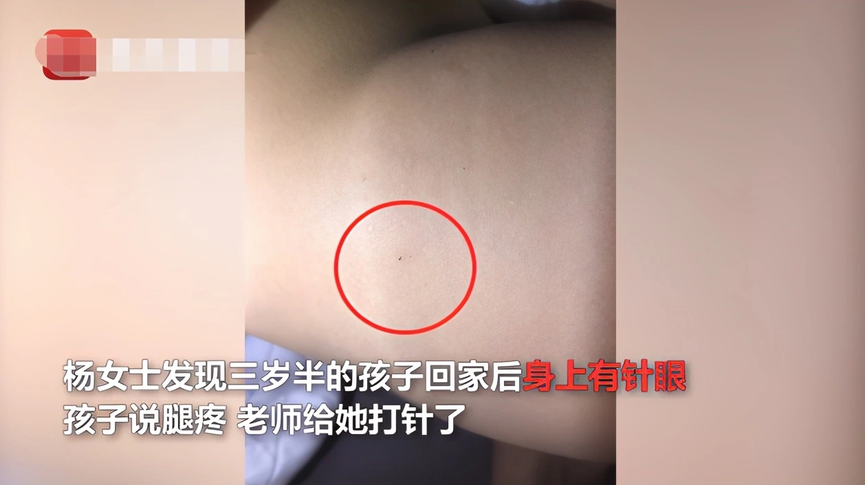 幼儿园3岁女孩说老师给她打针了，经检查后发现29处针眼，太可怕