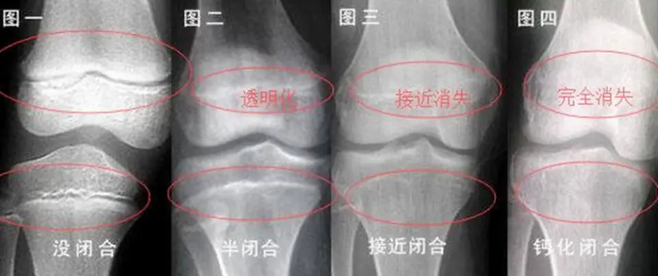 父母身高都“矮”，孩子将来能长高吗？最终身高关键还得看它！