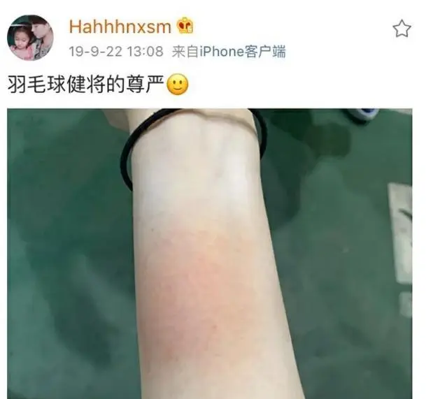 娇气女星鞠婧祎，连被咬蚊子包都要发博卖惨，却屡用替身被嘲