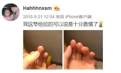 娇气女星鞠婧祎，连被咬蚊子包都要发博卖惨，却屡用替身被嘲