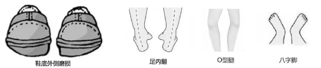 走路费鞋？你的步态问题，看鞋底就能知道！