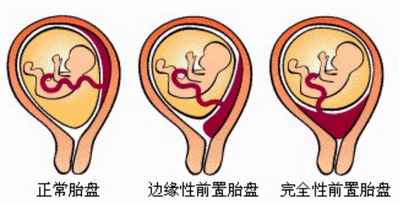 孕妇的肚脐为啥有凹有凸，难道和生男生女有关？这5点是主要原因