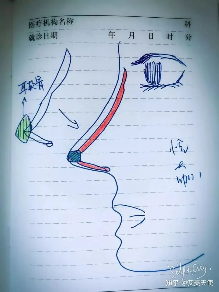 隆鼻的那些人到老了都怎么样了？