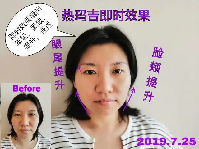 美容院常用的热玛吉，到底是何“神器”？爱美的女性，不妨看看