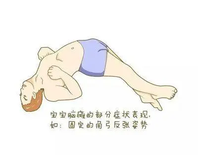 宝宝脑性瘫痪的原因，家长要知道，趁早治疗是关键