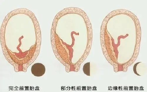 “肚子尖是儿子，圆是女儿？”孕妈别乱信，看看产科医生的说法